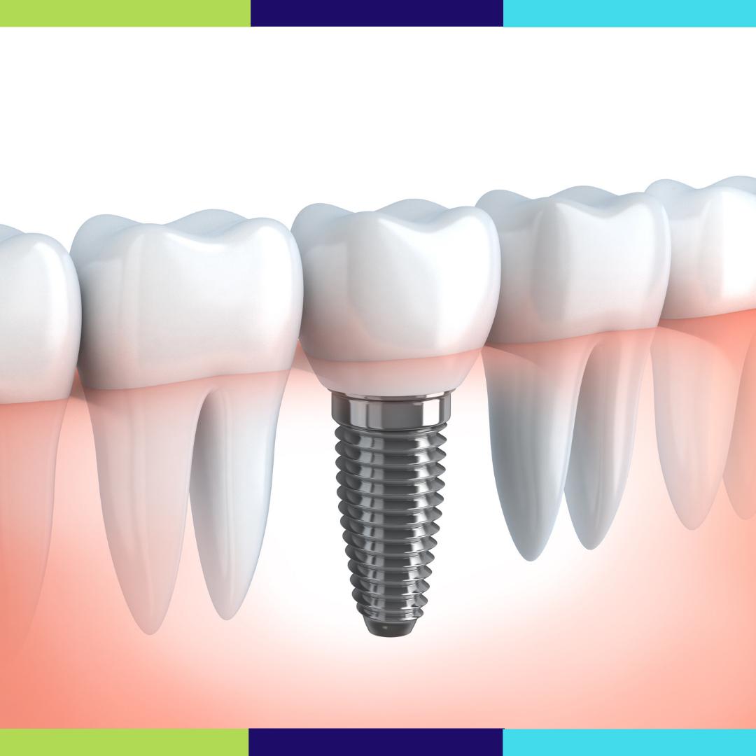 Missing a tooth or multiple teeth? Dental implants are an affordable way to complete your smile! Contact us to learn more about #DentalImplants today. 

(310) 651-8266
dentistoftorrance.com