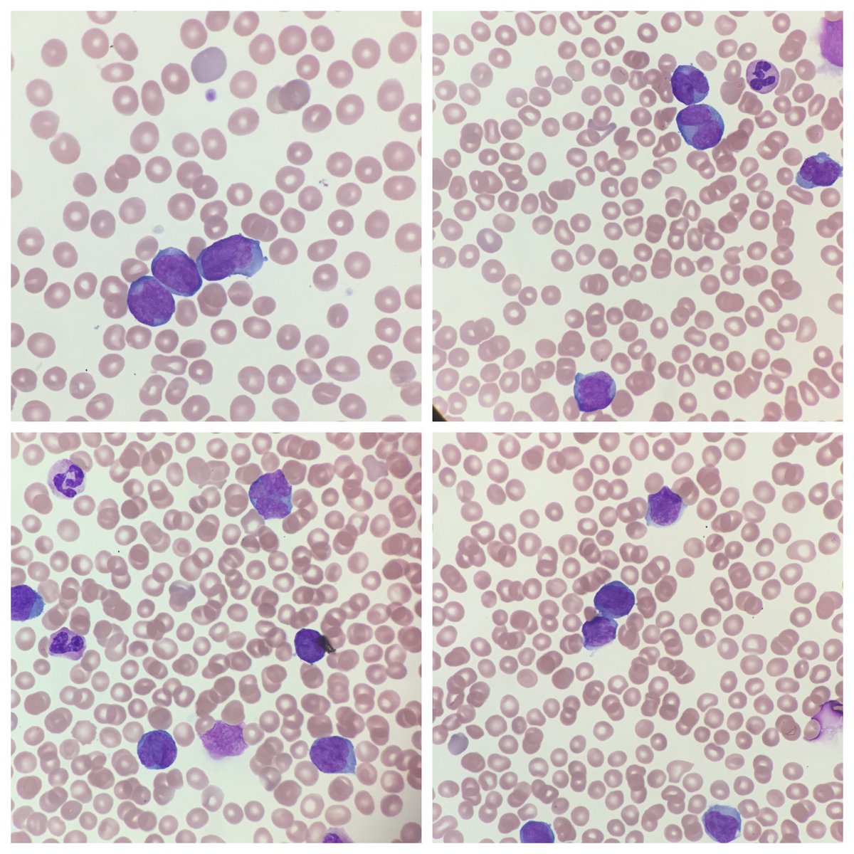 bluehatcomics85's tweet image. Its an amazing feeling to be able to come to the hospital late-night,diagnose AML and work with the Heme-Onc team to guide treatment for our patient. #IAmAPathologist#Enlight #hemepath @SUNYUpstatePath⁩ ⁦@DrFNA⁩ ⁦@smlungpathguy⁦@mjcascio⁩ ⁦@IUraizee3MD⁩