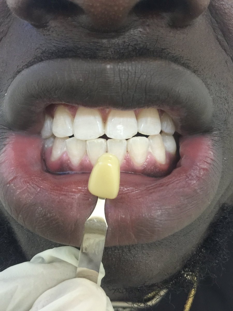 SmileCenterGh's tweet image. Smile Centre Gh is offering our customers with the best reliable laser treatment when it comes to teeth whitening #saynotoplaques #smilecentergh #teethwithening