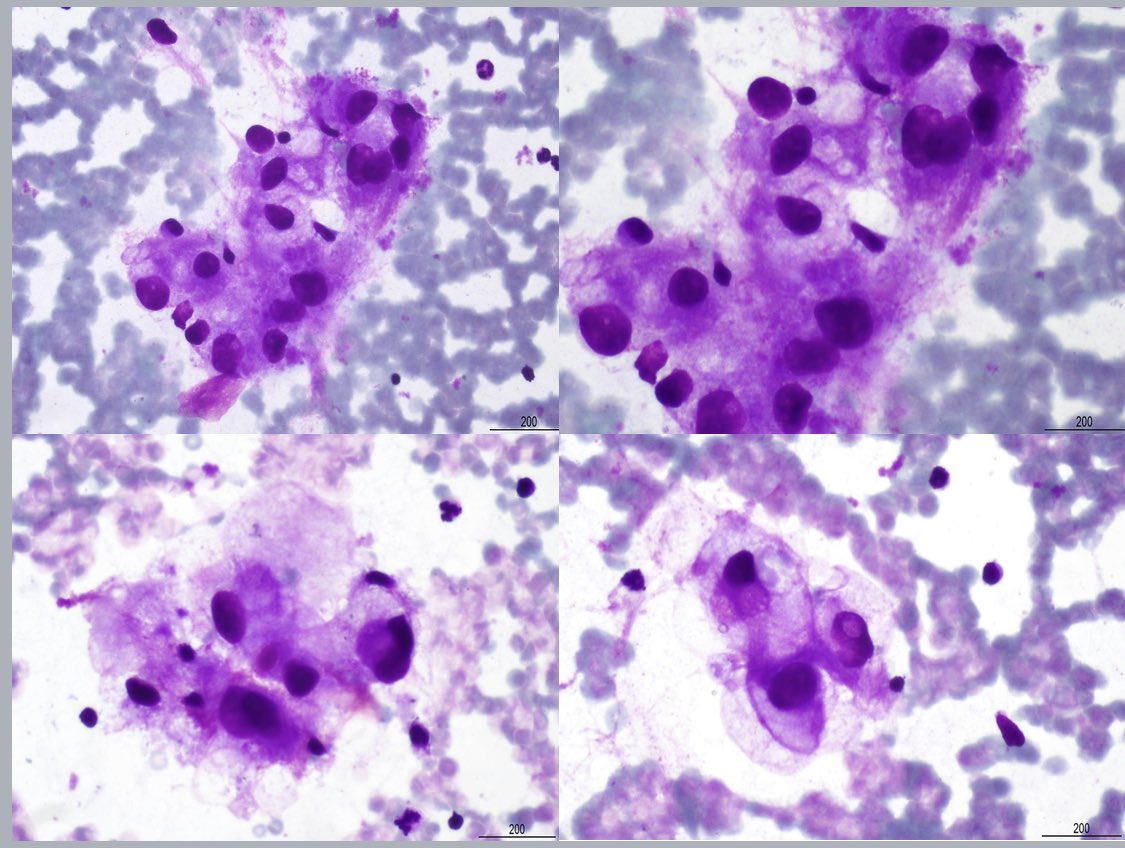 MyCytopathology's tweet photo. #Pap and #Diff_Quik stained smears of clear cell renal cell carcinoma. The characteristic #immunoprofile of this tumor is CK8+ and 18+ (markers of proximal convoluted tubules), CA IX+, CD10+ and RCC+. While CK7-, CK19-, AMACR-, and TFE3-. @SibaElHussein @SamKhader #FNA #CytoPath https://t.co/cb4oQPGUoN