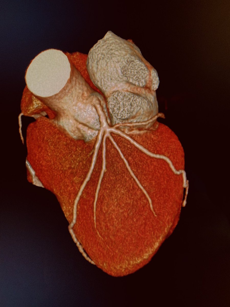 CSmuclovisky's tweet photo. #coronary #anatomy normal variant. Left main quintuplicates. #YesCCT @Heart_SCCT. https://t.co/kSEnKpQYbN