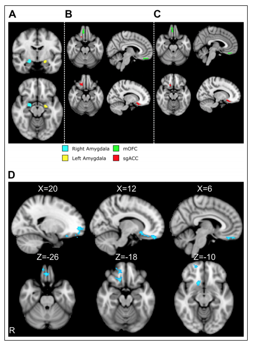 Atypical Prefrontal–Amygdala Circuitry Following Childhood Exposure to Abuse: Links With Adolescent Psychopathology journals.sagepub.com/doi/full/10.11…