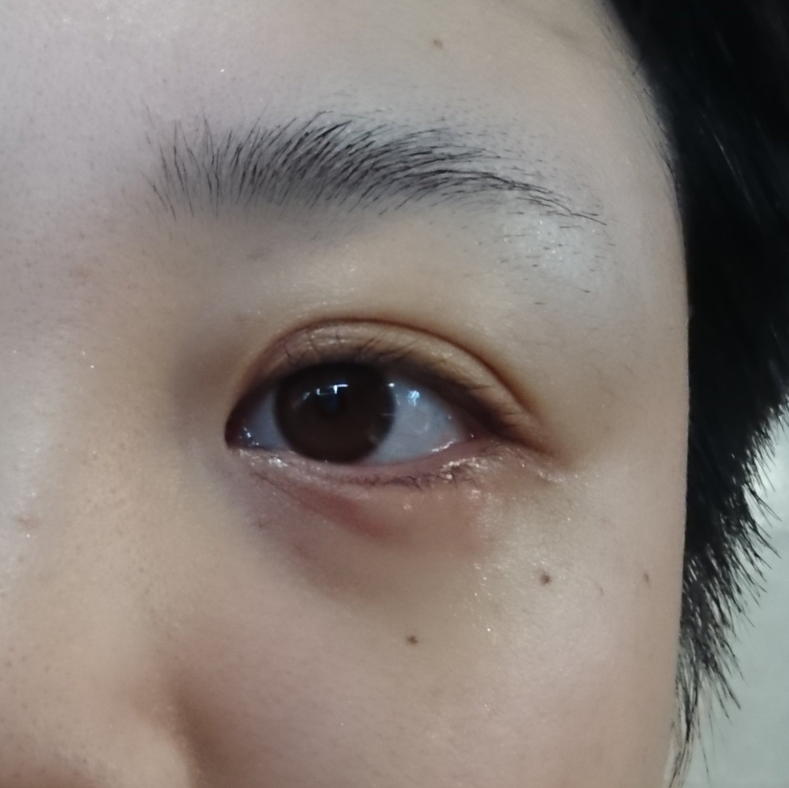 みかん🍊🍶0927amz福岡 on X: 目の下が虫刺されみたいに腫れてる？痛くも痒くもないんだが…なんじゃこりゃ_:(´ω`」 ∠):_  t.coUtOwXIxvdH  X