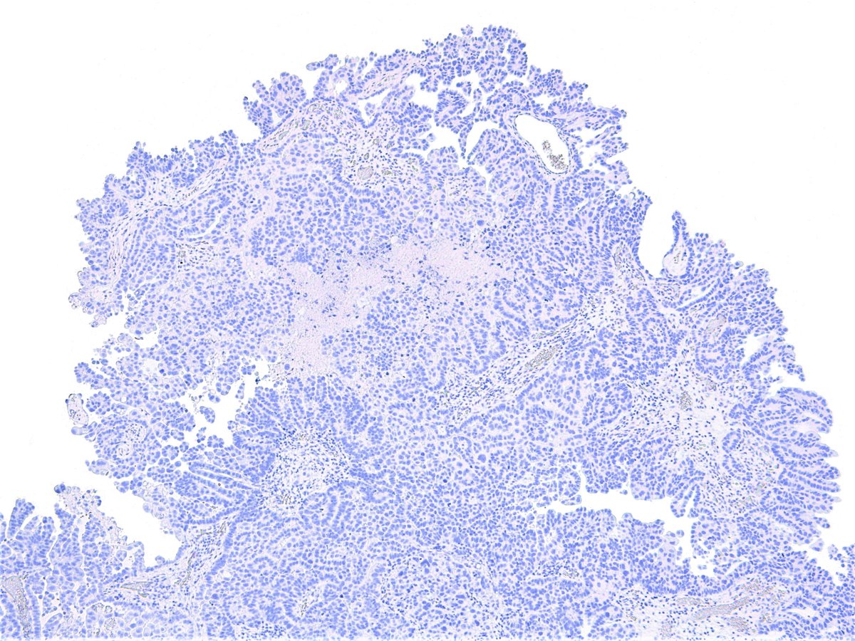 Patholwalker's tweet photo. Immunostains, HNF-1beta, p53, Vimentin, p16INK4A, respectively.

My final diagnosis is clear cell carcinoma of uterine corpus. However, I understand that there may be different opinions.#pathology #Gynpath
https://t.co/yjjJndzgUm https://t.co/4Wd87GqksM