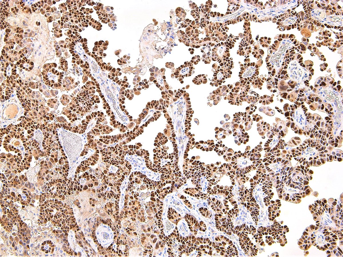 Patholwalker's tweet photo. Immunostains, HNF-1beta, p53, Vimentin, p16INK4A, respectively.

My final diagnosis is clear cell carcinoma of uterine corpus. However, I understand that there may be different opinions.#pathology #Gynpath
https://t.co/yjjJndzgUm https://t.co/4Wd87GqksM