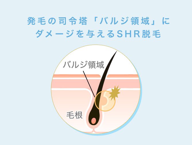 kobatomo_1's tweet photo. これ、バルジ領域にダメージを与える画期的な脱毛法って謳ってますが、所詮これまでのエステ脱毛と同じです。

要は、エステでは機器のパワーが低いので毛根（毛母細胞）まで破壊できないのを逆の発想で言い換えてるだけ。医療脱毛はバルジ領域も毛根も破壊しますから。
https://t.co/Kly8HQrDoy https://t.co/w00L9RyYZf