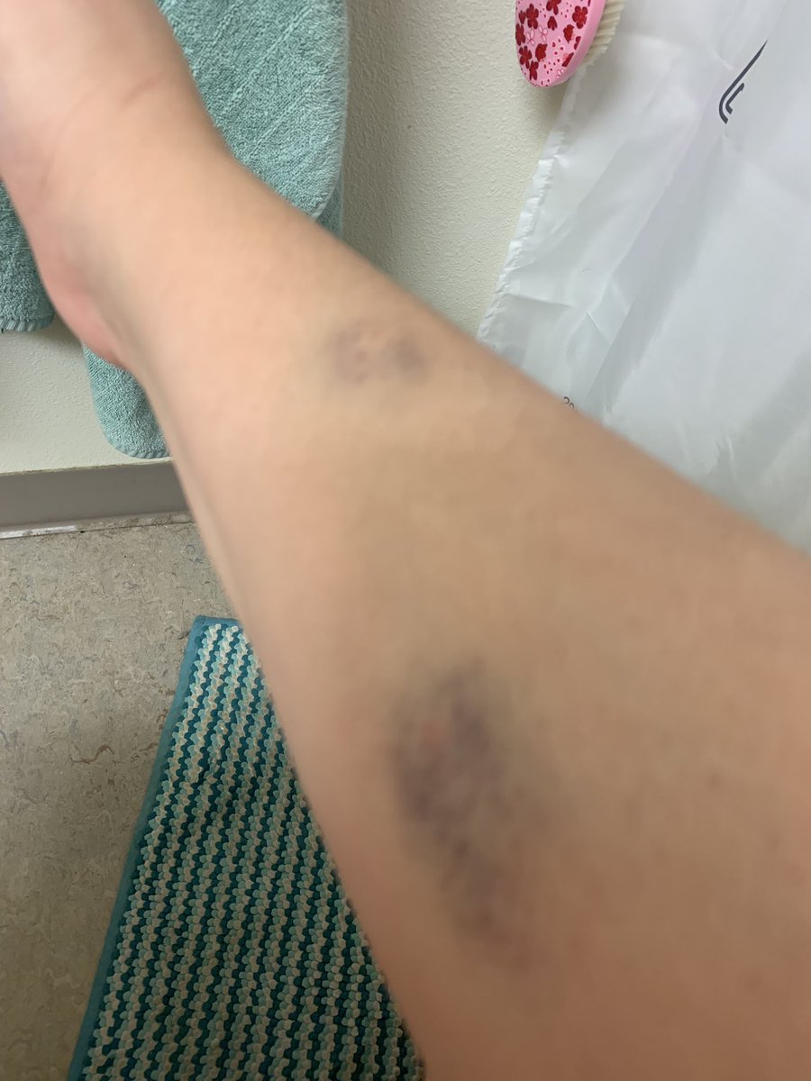 pdxfashionista's tweet photo. Behind the scenes, a thread: 1. Remicade Infusion day. 2. Crazy gazillion IV pokes bruises. 3. Tired and fed up. 4. My nighttime regimen. Contโ in comments. #SickPics #chronicillness #Migraine #Fibromyalgia #Psoriasis #psoriaticarthritis #NervePain https://t.co/OiBCRh99ir