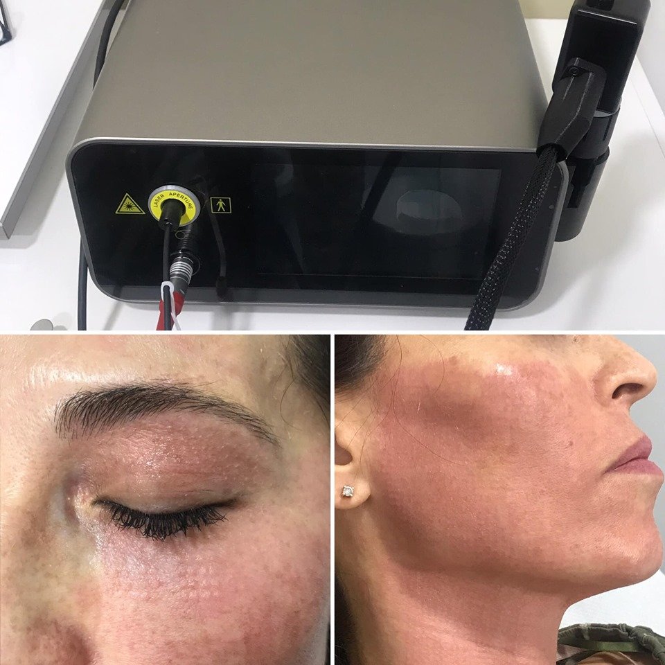 IrradiaSB's tweet photo. Conoce las ventajas que ofrece #LightScan. Un escáner de ata precisión que incorpora #Lasemar1500 permite realizar tratamientos de #rejuvenecimiento fraccional no ablativo para mejorar la calidad de la #piel.
Os dejamos con un resultado en Clínica LUNIK.
https://t.co/dDRkSuq7hR https://t.co/wEGWc3E2wD