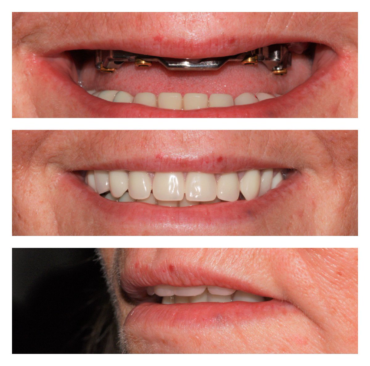 Removable telescopic Over Denture@Ldentec.