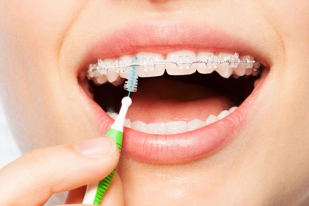 DrCulpJungleRts's tweet image. In our last orthodontic article, we discussed answers to some common questions about orthodontics and in this article, we are going to focus on questions about rubber bands. 

j.mp/2HFPY3U

#braces #arizona #phoenix #chandler #ahwatukee