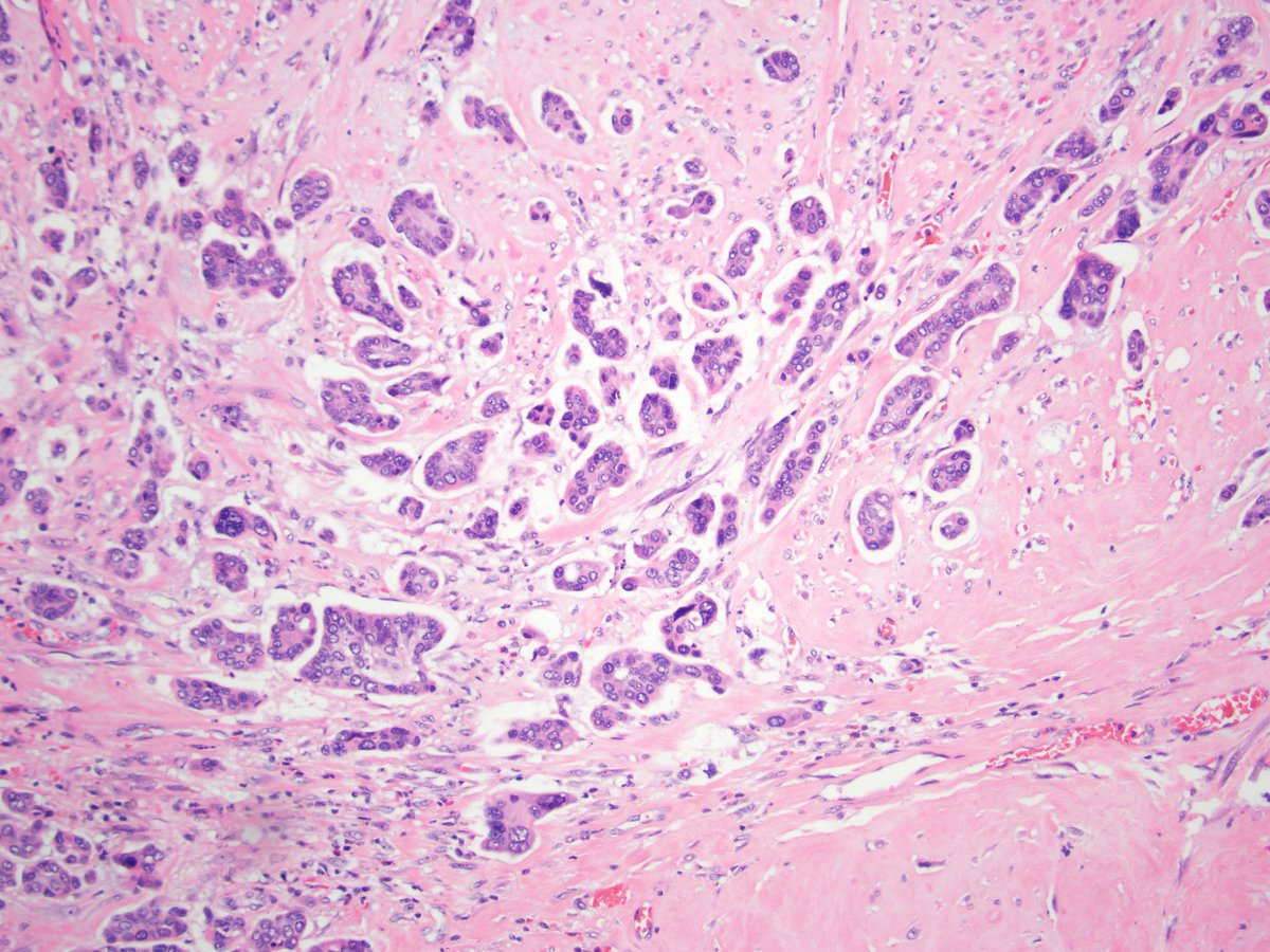 drmehrarohit's tweet photo. Urothelial carcinoma with micropapillary features- often associated with high stage, LVI, Mets &amp; poor outcome #bladdercancer @UMichPath #gupath #urology https://t.co/qwI4PC6oDw
