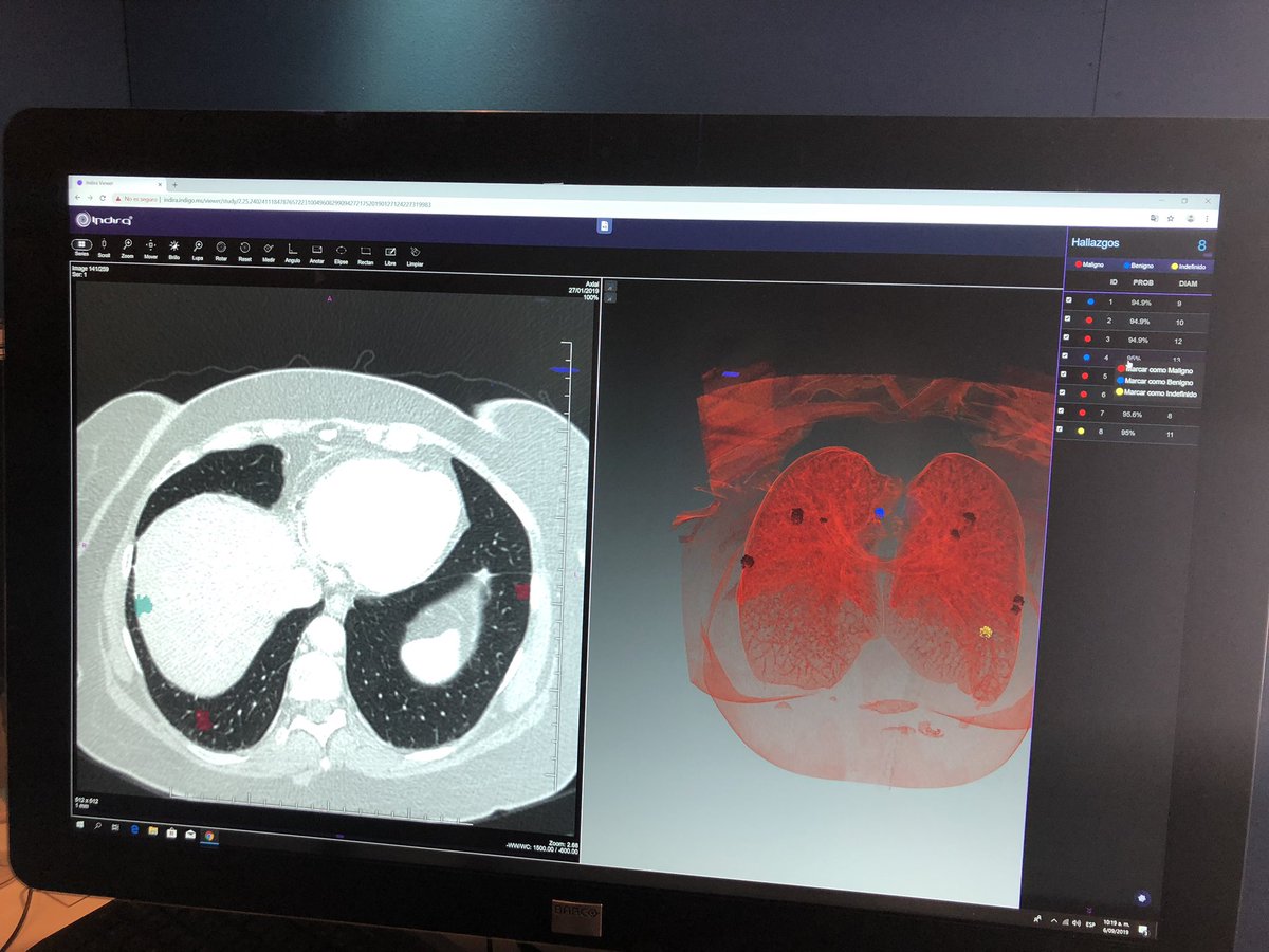 Carolina_tipo1's tweet photo. Indigo Technologies desarrolló un programa para detectar con precisión cáncer de hasta 3mm que pueden ser imperceptibles con otros exámenes diagnósticos 👏🏻 #esaludLATAM #SaludConectada https://t.co/5Vg0bjdykL
