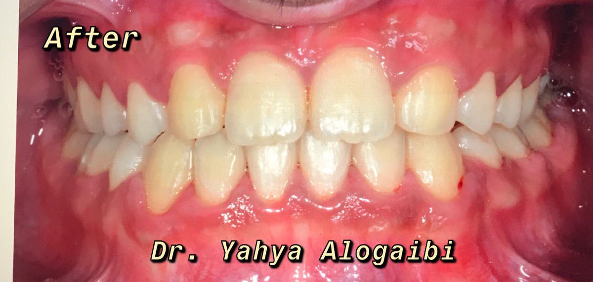 dr_alogaibi's tweet photo. Class III Malocclusion complicated with congenitally missing laterals, retained 52 &amp;53, impacted 13 and anterior &amp; posterior crossbite.
Treated with:
Extraction lower 4s, retained 52 and 53 
Canine exposure # 13
Substitution canines for laterals &amp; upper 1st premolars for canines https://t.co/q8ov5PAPwv