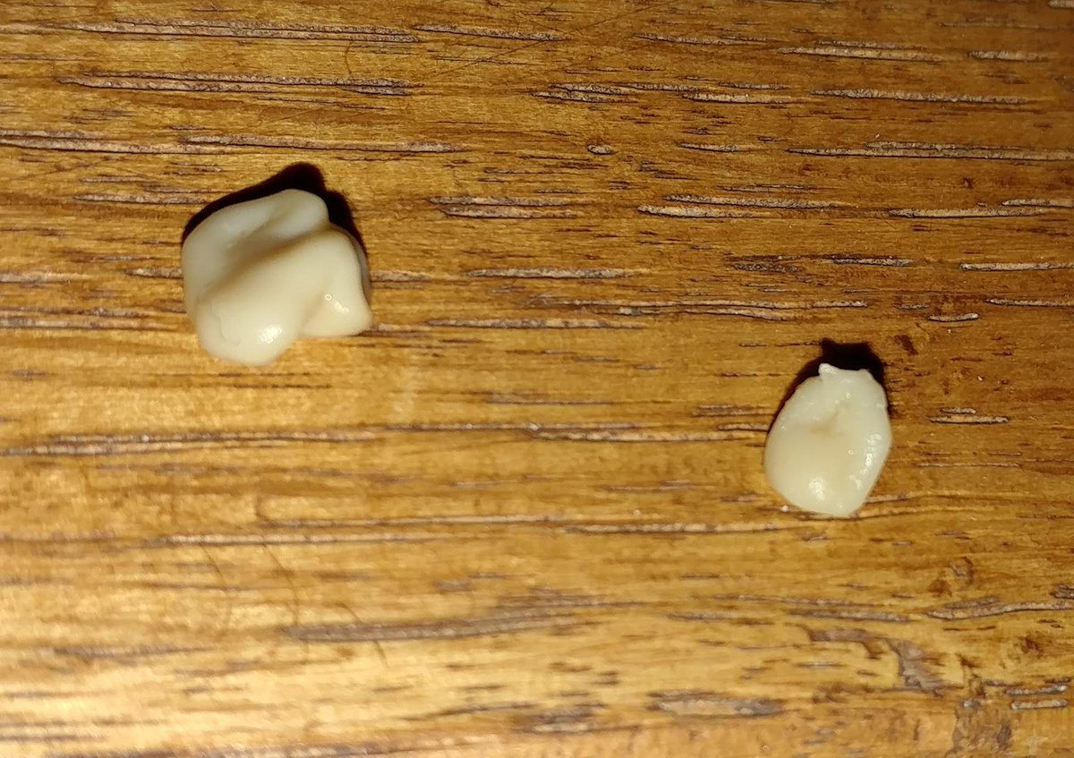 TonsilStonePics's tweet photo. Personal #TonsilStones from 9/21/2019 https://t.co/ieyC7kmmiV