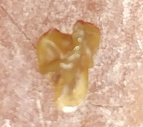 TonsilStonePics's tweet photo. Personal #TonsilStone from 8/24/2019 after sitting around for 3 days https://t.co/hxBHWGdats