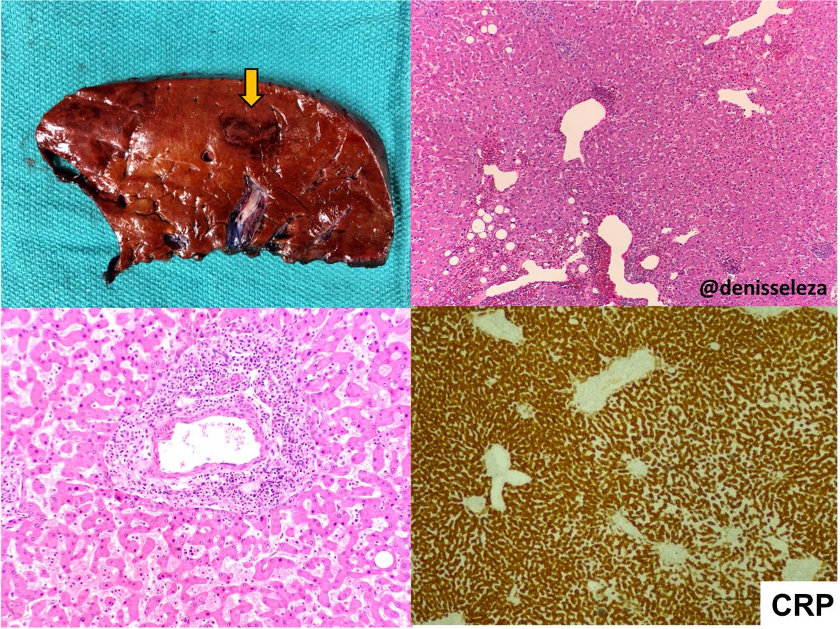 Hepatic adenoma, inflammatory subtype. Gross: Well demarcated tan-brown lesion. H&amp;E: Sheets of hepatocytes with telangiectatic features. Pseudoportal tracts, dilated sinusoids and chronic inflammation. Immunoreactivity to acute phase reactants: CRP and SAA. @denisseleza