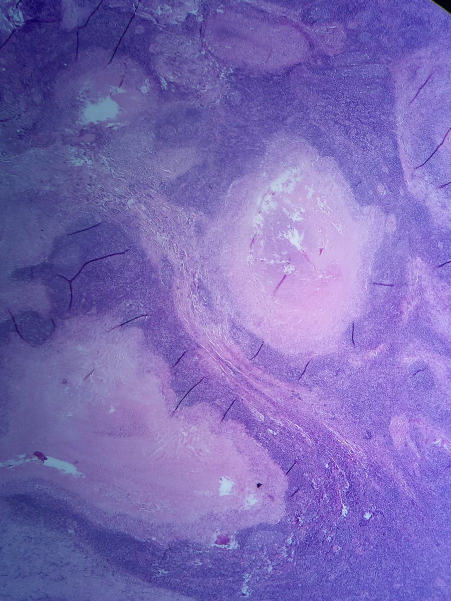 pipoulou_kgb's tweet photo. 🐑🔬#infectiouspath #infpath 🔬🐑 43YOM shepered with epitrochlear lymph node ... 🔦granulomatous necrotizing and suppurative lymphadenitis with 🔦 @Infectiousdise6 @pembeoltulu @smlungpathguy @doc_infect @TheLancetInfDis @InfectiousDz @ACS_Infectious @ParasiteGal @ImperialInfect https://t.co/AprW74zg2e