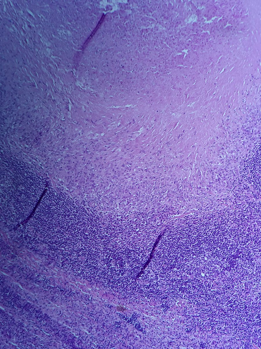 pipoulou_kgb's tweet photo. 🐑🔬#infectiouspath #infpath 🔬🐑 43YOM shepered with epitrochlear lymph node ... 🔦granulomatous necrotizing and suppurative lymphadenitis with 🔦 @Infectiousdise6 @pembeoltulu @smlungpathguy @doc_infect @TheLancetInfDis @InfectiousDz @ACS_Infectious @ParasiteGal @ImperialInfect https://t.co/AprW74zg2e