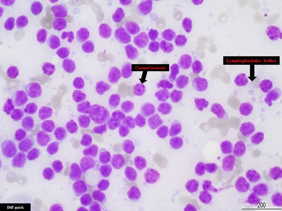SamKhader's tweet photo. A neck #lymph_node #FNA in a patient with CLL/SLL. A monotonous population of mainly mature small lymphocytes with very scant cytoplasm and clumpy chromatin. A few prolymphocytes and paraimmunoblasts are also present. Notice the absence of tingible body macrophages. @SaeedAsiry https://t.co/lJvtfDczlC