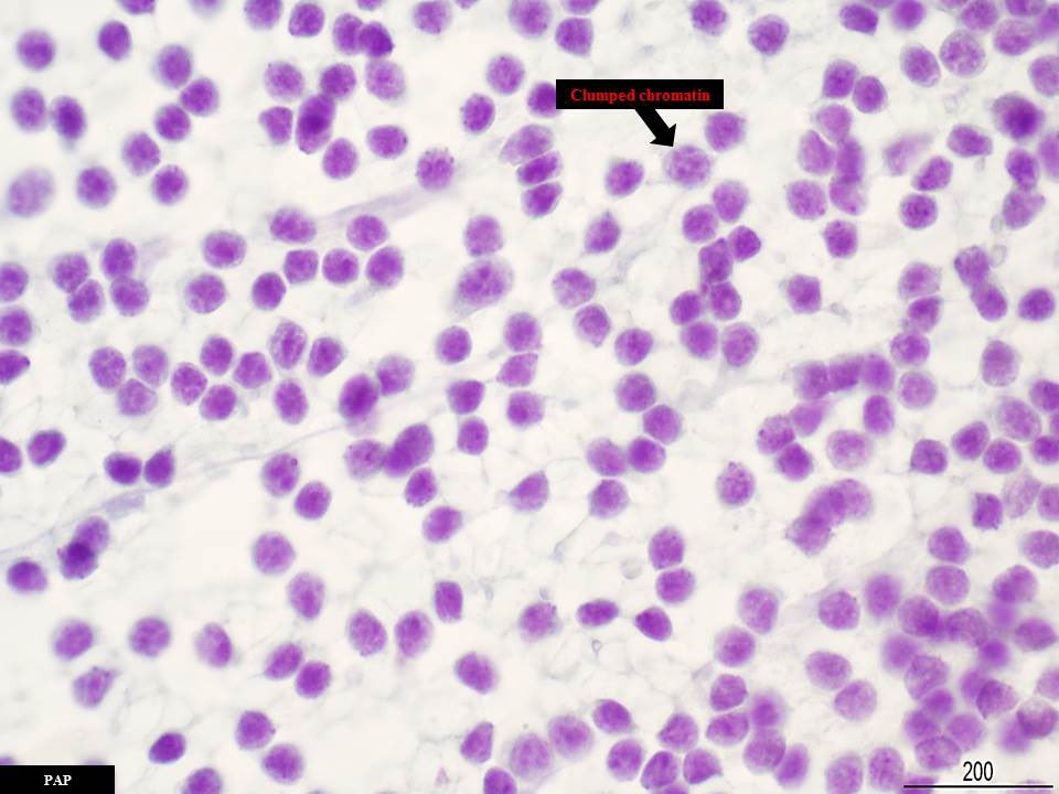 SamKhader's tweet photo. A neck #lymph_node #FNA in a patient with CLL/SLL. A monotonous population of mainly mature small lymphocytes with very scant cytoplasm and clumpy chromatin. A few prolymphocytes and paraimmunoblasts are also present. Notice the absence of tingible body macrophages. @SaeedAsiry https://t.co/lJvtfDczlC