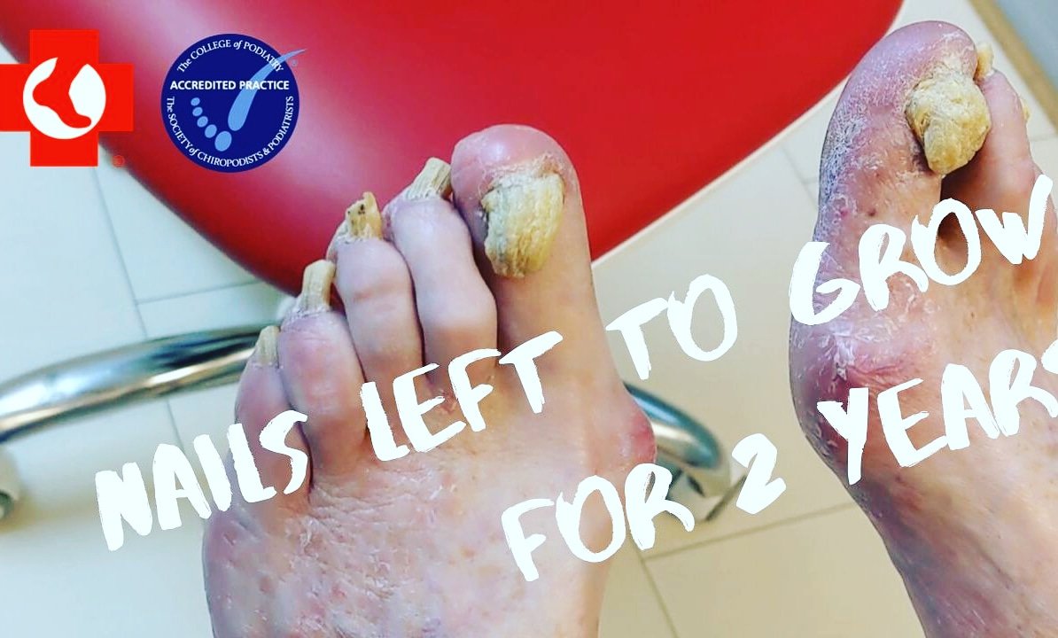 Unbelievable nails. Untouched for 2 years!! Check out our latest video on our youtube channel to see our latest case. Dont forget to like, comment and subscribe if you find it interesting or know someone who could benefit. 
youtu.be/AR_oEQlDmHU