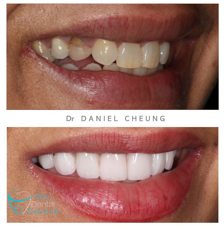 Visit our Instagram and website for more
#Bury #Buryhour #Dentist #compositebonding #invisalign #compositeveneers #whiteteeth
dentistinbury.co.uk