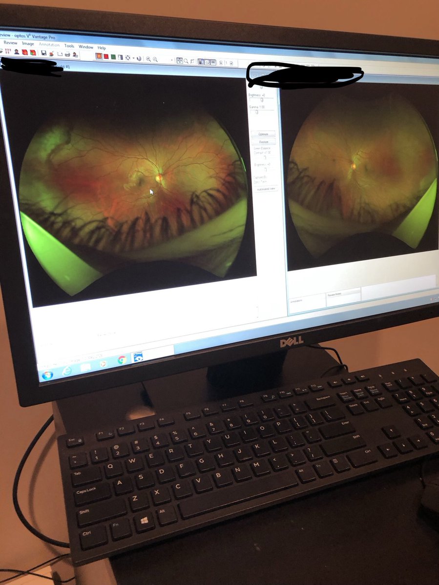 peacemaker_tv's tweet photo. I haven’t been to the eye doctor in years. The technology has changed so much. Let me share with u the spooky picture of the back of my eyes. 🤣 https://t.co/gwObttPDyO