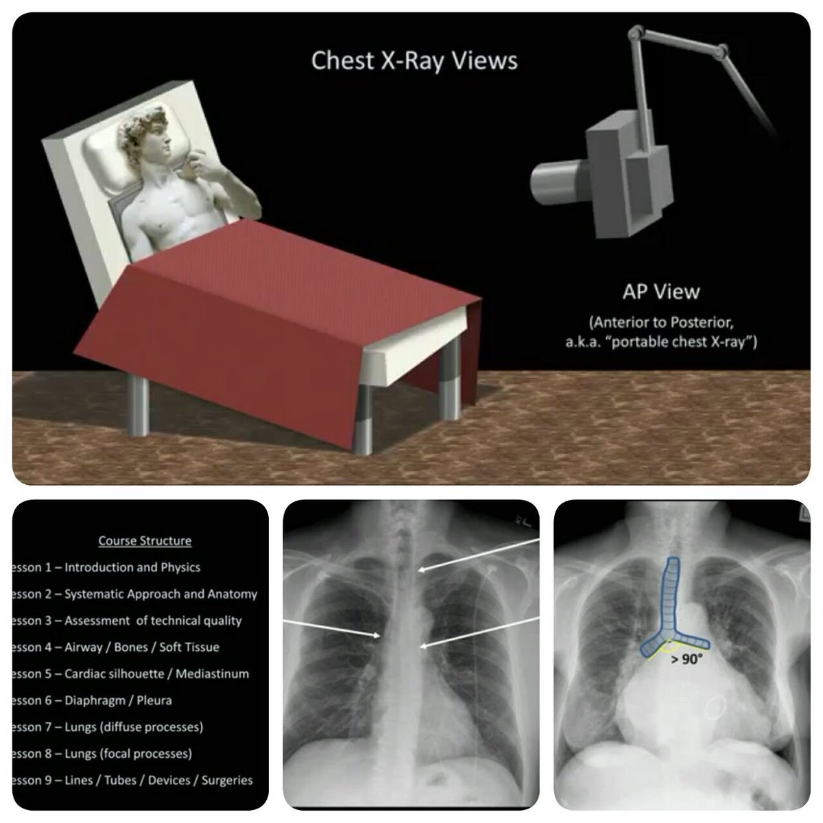 كيف تقرأ الـ chest x-ray ؟

حاجه مهمه كل طالب المفروض يعرفها عاجلا أم آجلا
هنا في هذه القناة على اليوتيوب سلسله من الفيديوهات لشرح مبادئ قراءة صورة الصدر البسيطة 
أرجو أن تكون مفيدة

دعواتكم لأمي وأبي بالرحمه والمغفره 🙏🏻♥️

m.youtube.com/playlist?list=…