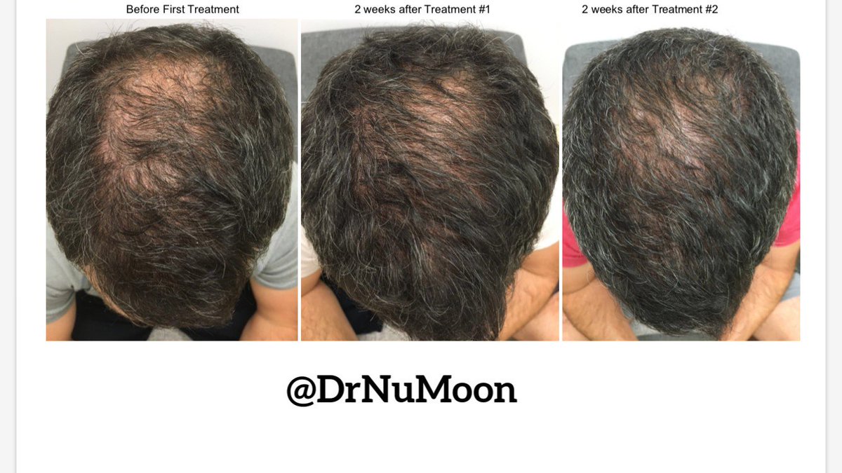 Introducing our latest solution for Hair Loss! We are the first and only clinic offering this treatment in NE Florida. Visibly thicker hair. Faster results than PRP &amp; with less discomfort! Call us today a consult &amp; let's get started! #hairloss #androgenicalopecia #nomorethinhair