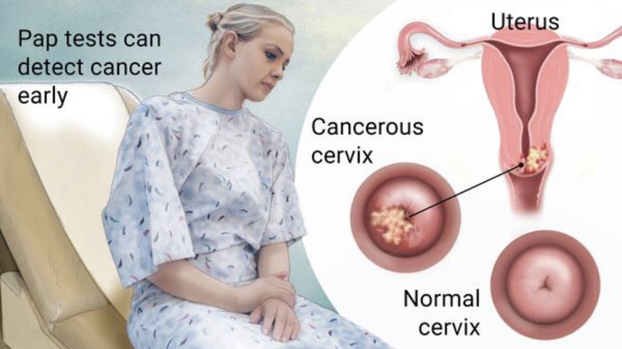 Causas de cancer de utero Causas de cancer de utero