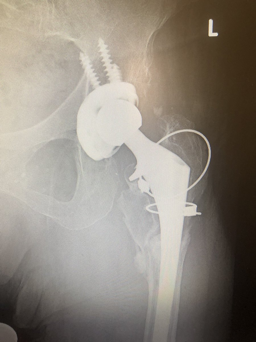 DrLeeRubin's tweet image. Dr. Rubin: How is your left hip feeling since the last visit? (Historic THA revision from many years ago)

Patient: I’ve been taking glucosamine supplement to help with my cartilage and my hip is feeling much better!

Rubin: 🤔