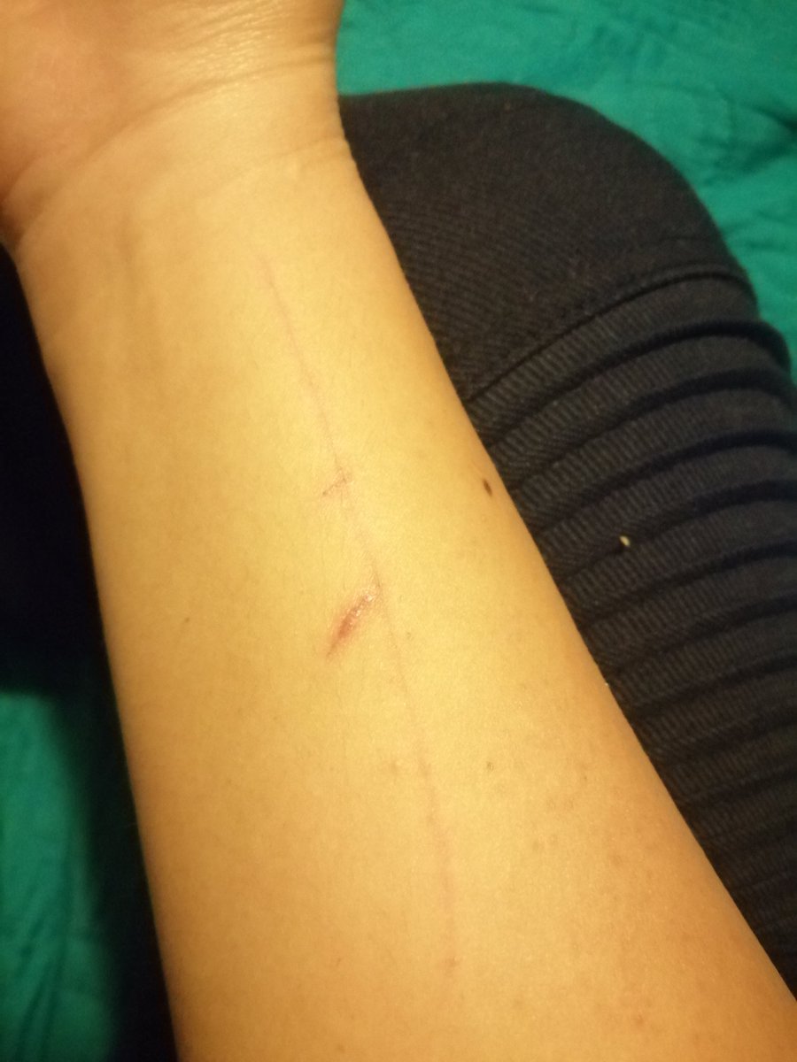 LALERUIZ's tweet photo. Tanto aruñón merece un tatuaje para tapar semejantes cicatrices. No sé ni cómo ni con qué me hice ese enorme 😑😒
#AruñónDelDía #BuscandoExcusas https://t.co/WEFt6rX2db
