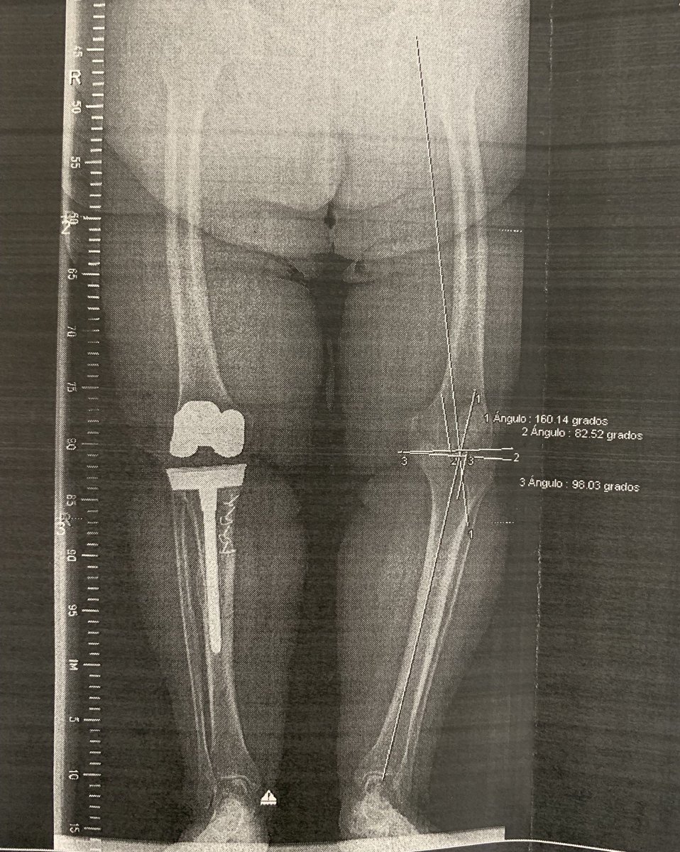 PlanificacionQx's tweet photo. #cirugía primaria #rodilla. En pacientes con IMC>35%, sobre todo mujeres con osteoporosis se recomienda vástago tibial. Control Rx satisfactorio. Dr. Alonso Lison @DrAlonsoLison https://t.co/Vl3vmVhDfD