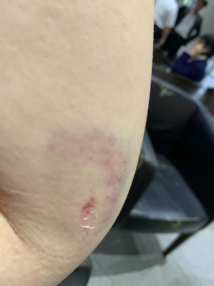 自転車 で 転ん で 膝 が 痛い