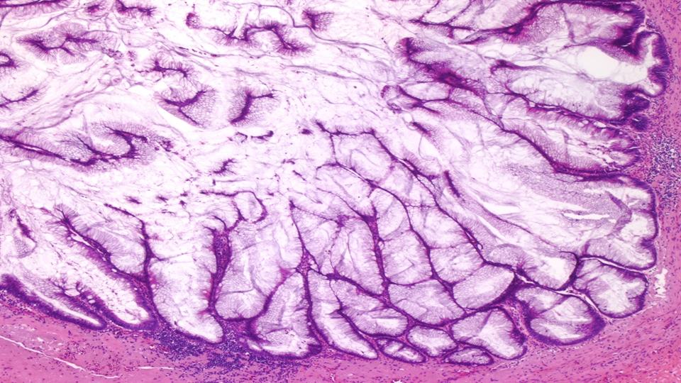CArnoldMD's tweet image. What is this appendiceal lesion? 
Significance of the mucin?
Stage?
Risk of PMP?
What to tell the surgeon re MGT?
Join the @USGIPS session at #CAP19 for @Jmisdraji  practical approach to this high-stake site! Details below. 

@Pathologists #GIPATH #TwitterTeaser #cap #cap2019