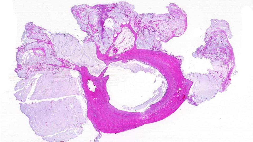 CArnoldMD's tweet image. What is this appendiceal lesion? 
Significance of the mucin?
Stage?
Risk of PMP?
What to tell the surgeon re MGT?
Join the @USGIPS session at #CAP19 for @Jmisdraji  practical approach to this high-stake site! Details below. 

@Pathologists #GIPATH #TwitterTeaser #cap #cap2019