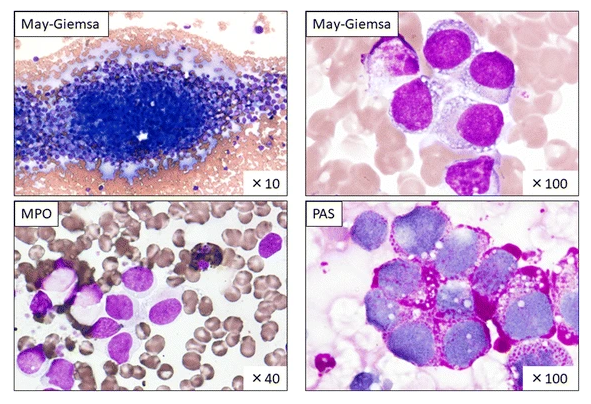 evemariecrane's tweet photo. @OncoBioMed @BioMedCentral Other #ChildhoodCancer types can extensively involve bone marrow and mimic leukemia.  Here is an interesting case where rhabdomyosarcoma was detected as CD56+ cells by flow cytometry https://t.co/zIhLpdeeyk
#SmallRoundBlueCellTumors are one reason  #WhyPathologistsMatter https://t.co/RzZkRq2Nyh