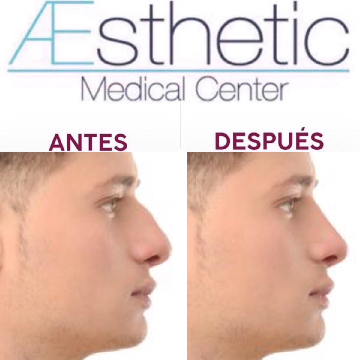 AestheticMC's tweet photo. #Rinomodelación, consiste en modelar o perfilar la nariz, con un material de relleno #AcidoHialurónico de alta densidad.
#facelift #medicinaestetica #rejuvecimiento #paraellosyellas #rinomodelacionsincirugia #fillers #rellenosfaciles #liftingfacial #fitness https://t.co/Lq7F3HNEiN