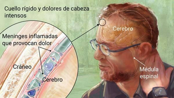 *LA MENINGITIS*
Es una inflamación de las membranas (meninges) que rodean el cerebro y la médula espinal. Los síntomas en general pueden ser dolor de cabeza, fiebre y rigidez en el cuello. La meningitis puede ser viral, bacteriana, parasitaria y micótica.
#AprendiendoCadaDia