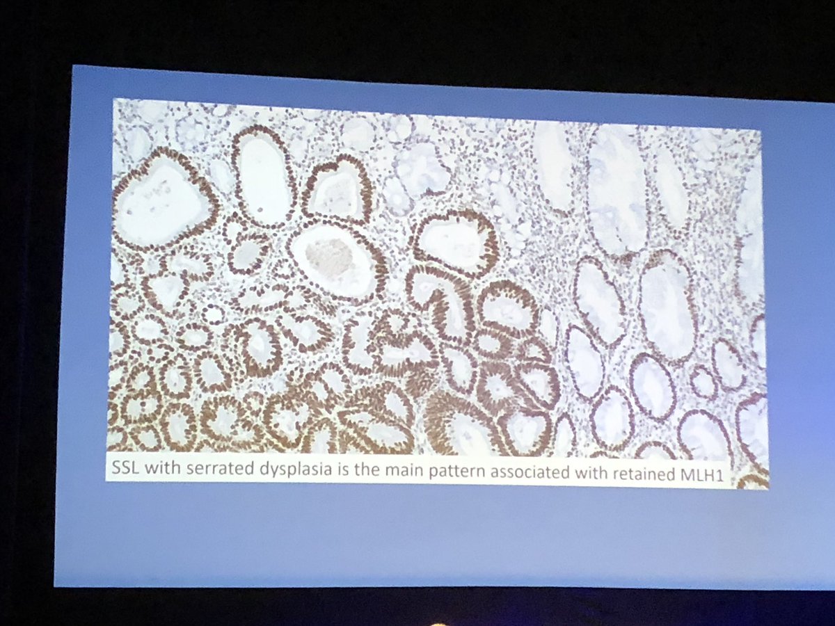 SSL with dysplasia 

By Christophe Rosty

#ECPNice2019 #ECP2019Nice #PathologyisNice #GIpath