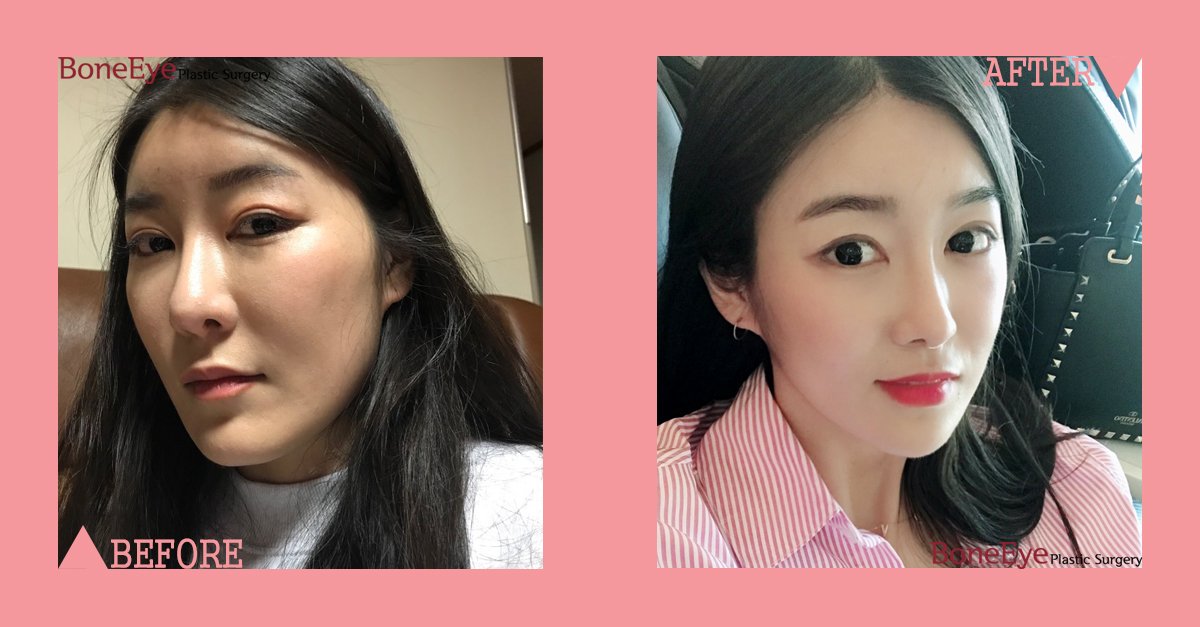 BoneeyePlastic's tweet photo. 💞 If you could have this smooth face-line, wouldn't you?
✔️ facial contouring

#boneeye #faceline #facial_contour #zygoma #cheekbonereduction #3D_zygoma #3D_cheekbone_reduction #angle_reduction #genioplasty #Korean_clinic #Dr_moon #Korean_hospital #Koreangirl https://t.co/jHVF7RPnql