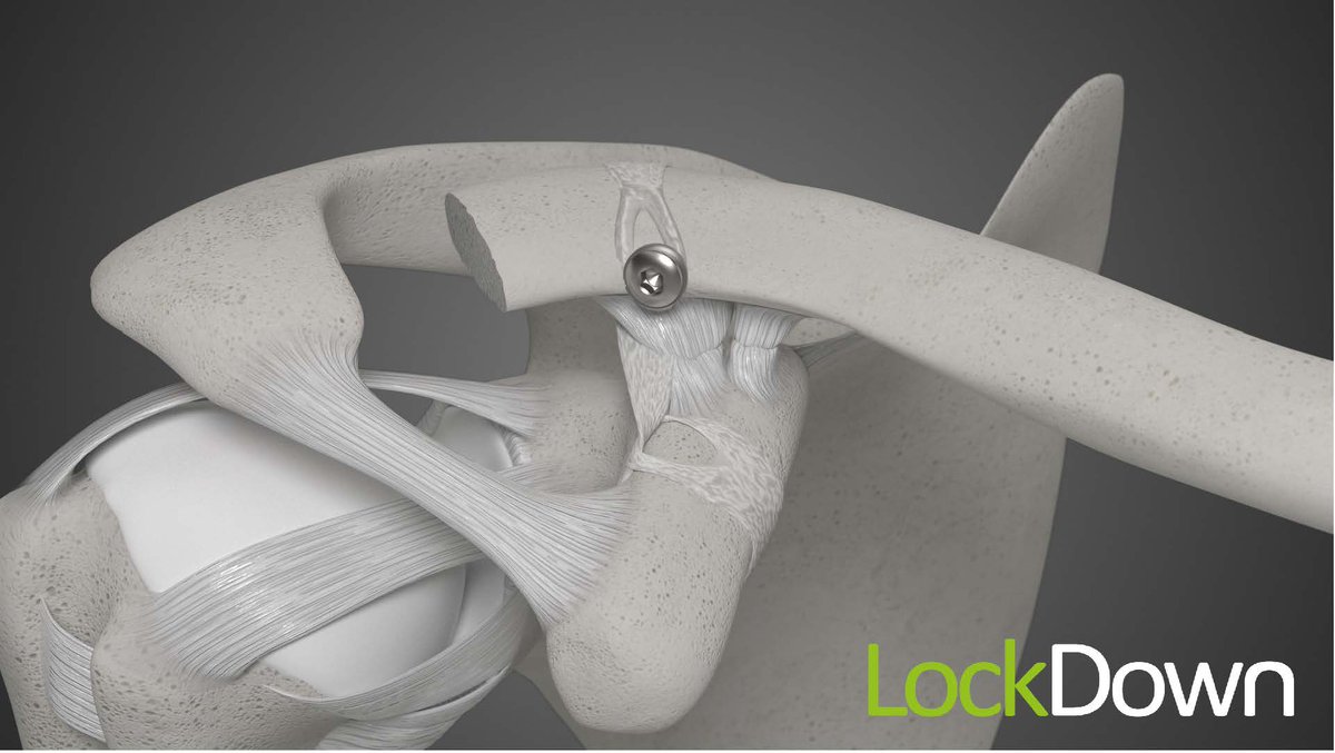 LockDownMedical's tweet photo. The LockDown device is a reliable and strong way to successfully reconstruct the acromioclavicular joint, providing AP stability in both acute and chronic cases. Click here to view the surgical technique animation https://t.co/kEFxOe7UC8 #lockdown #acjstability #acute #chronic https://t.co/ALbKuaWcEw