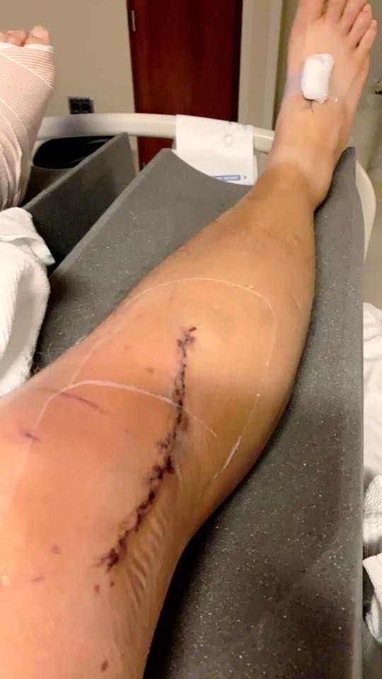 "Friendly reminder since I’m now sitting in the hospital with a broken sternum, both legs, left arm and back. I was putting up stands for this years bow opener. Wear your safety harness!"

Jason Glessing, Wisconsin Rut Report

#WhatGetsYouOutdoors #Bowhunting #DeerHunting