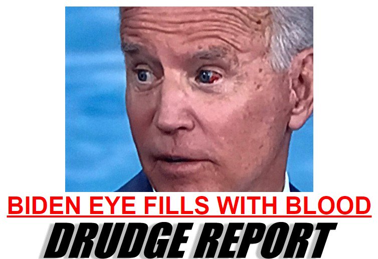 Byron York on Twitter: "Joe Biden blames eye bleeding on contact lens. From  @laconiadailysun: https://t.co/quFwCBJZ5U https://t.co/WFduT3VBRV" / Twitter