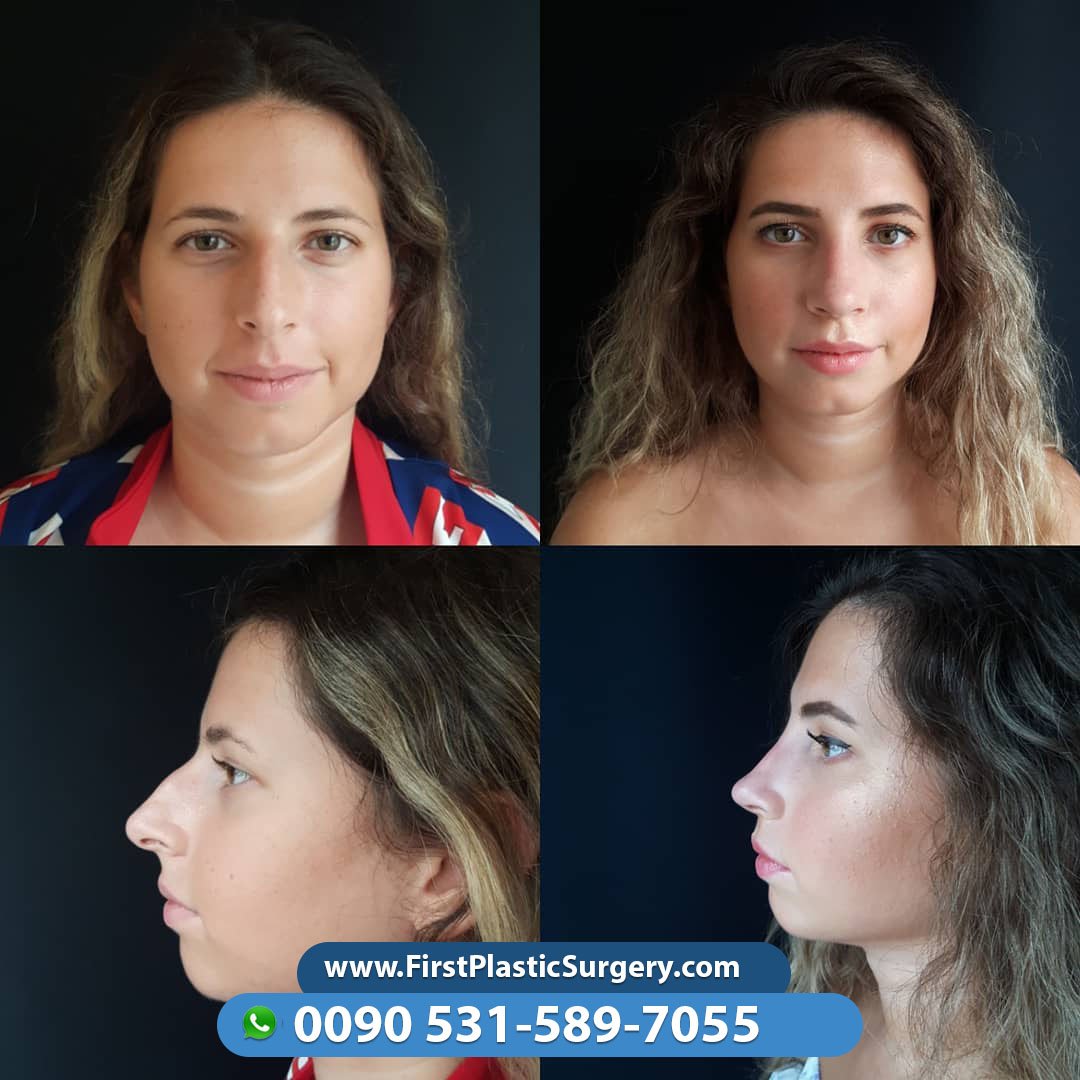 CosmeticsTurkey's tweet image. Contact us via Viber/WhatsApp 🇸🇦🇹🇷🇫🇷🇬🇧🇩🇪🇳🇱
📞00905315897055 ☎
firstplasticsurgery.com
😍😍🇹🇷🇹🇷😍🇹🇷😍🇹🇷😍🇹🇷🇹🇷😍😍🇹🇷😍😍
#facelift #cosmeticsurgery #confidence #selfconfidence #antiaging #naturalresults #eastcoastplas