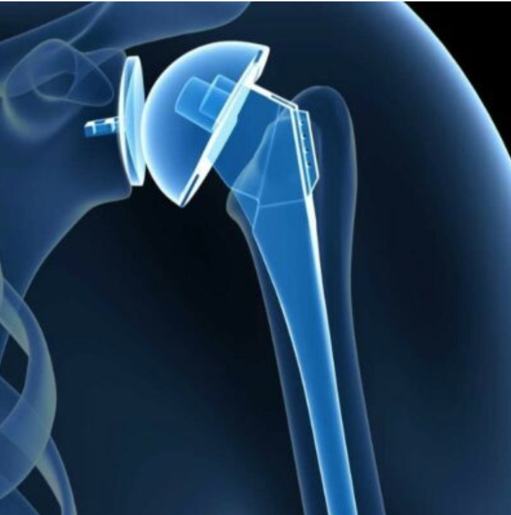 Flazzaraville's tweet photo. #TotalShoulderReplacement also known as total shoulder arthroplasty, is a successful procedure for treating severe pain and stiffness that is often the result of end-stage arthritis or degenerative joint disease. https://t.co/lTGtQV7KER https://t.co/MQrdb8okfs