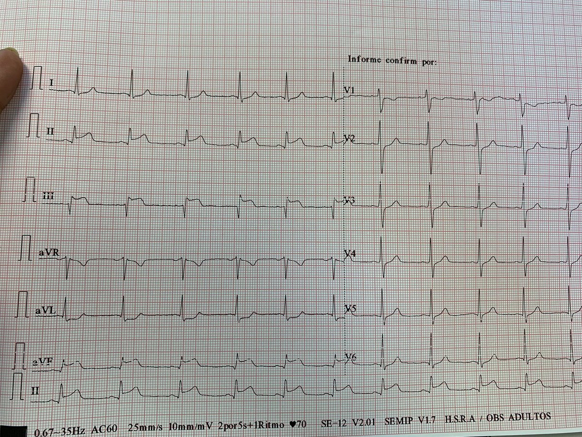 kikkiv's tweet image. Masculino de 31 años, obeso, no HTA, no DM, no tabaquismo, que consulta por cuadro de dolor torácico #CodeSTEMI
