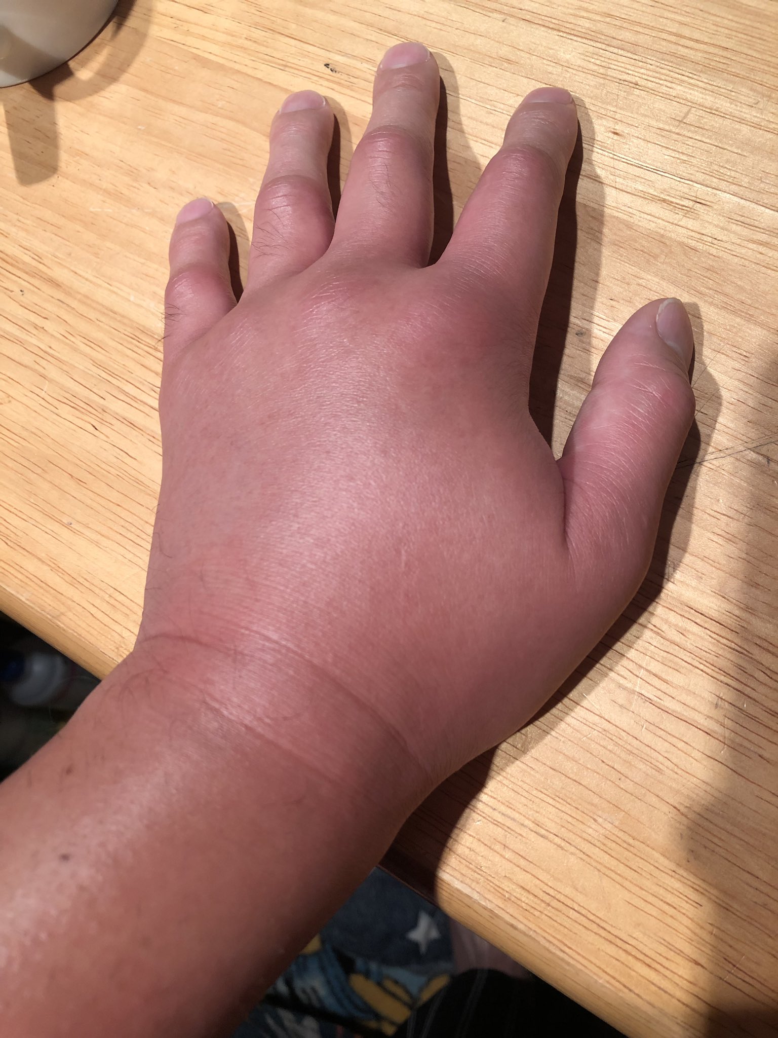 まていさん あかん 腕パンパンに腫れた 赤ちゃん並みのぷくぷくに 蜂に刺される T Co 6lf92xhhtl Twitter