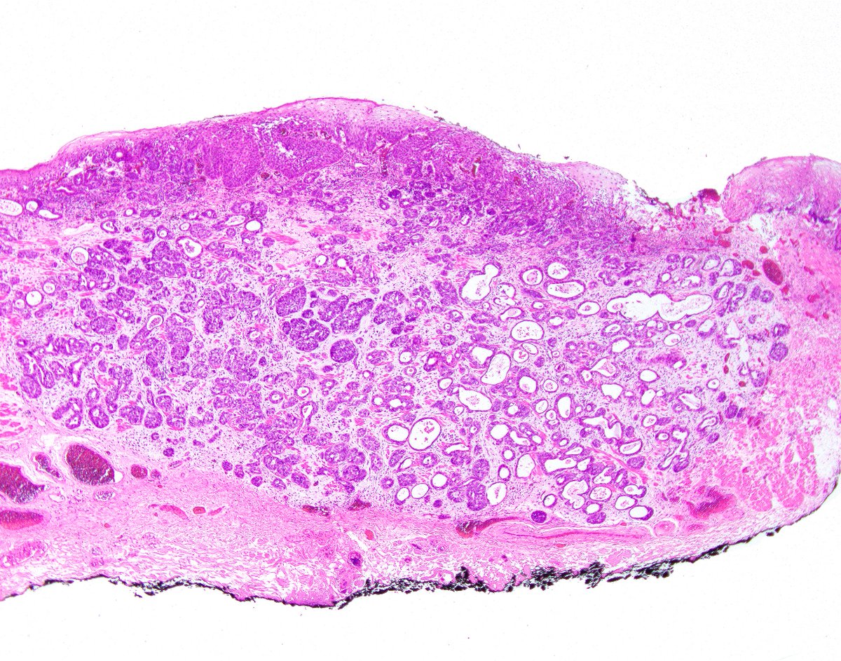science_press's tweet photo. This esophageal adenosquamous carcinoma has arisen in association with a squamous precursor. https://t.co/11aBMJG2Yg https://t.co/I4b8GwjMh1