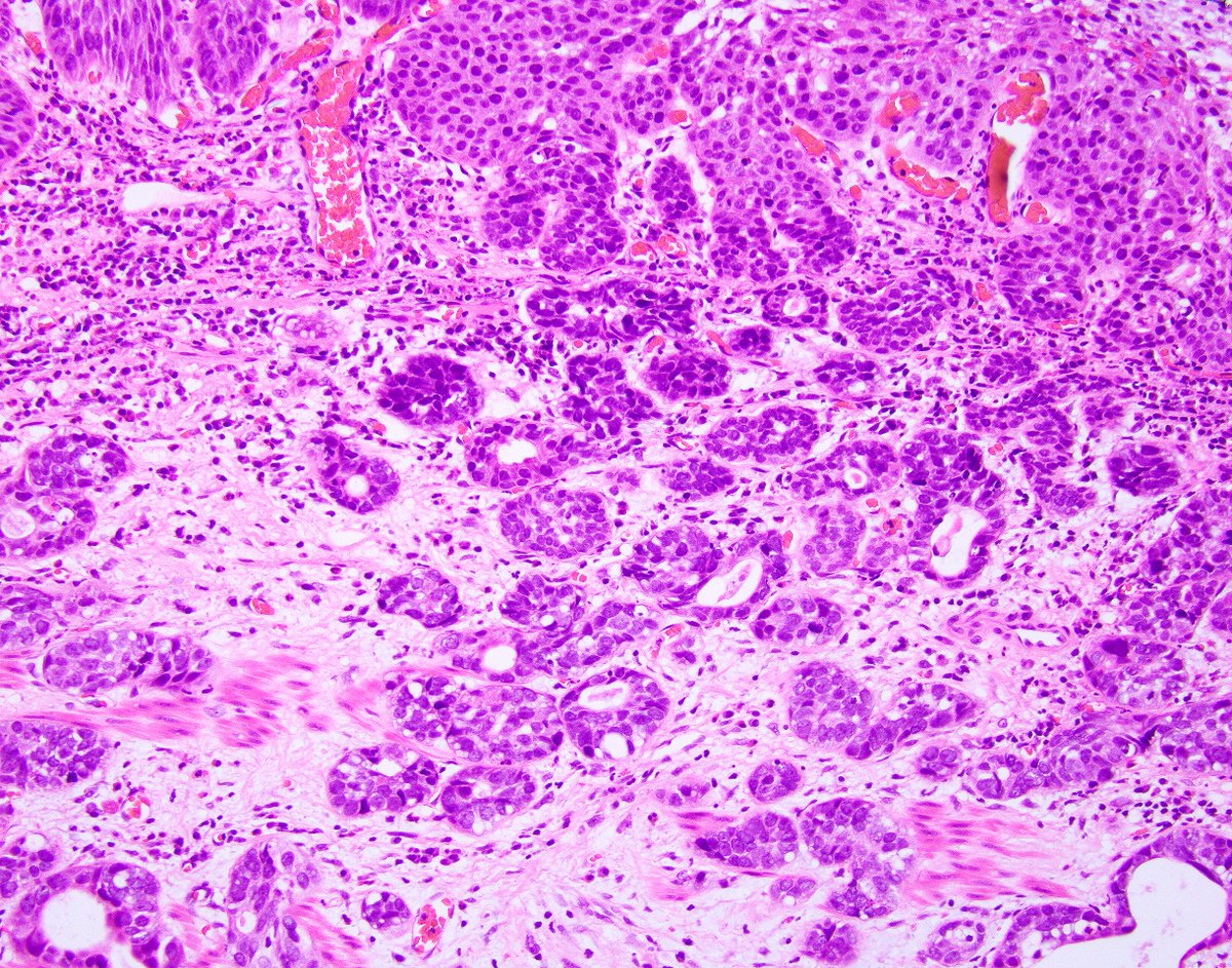 science_press's tweet photo. This esophageal adenosquamous carcinoma has arisen in association with a squamous precursor. https://t.co/11aBMJG2Yg https://t.co/I4b8GwjMh1